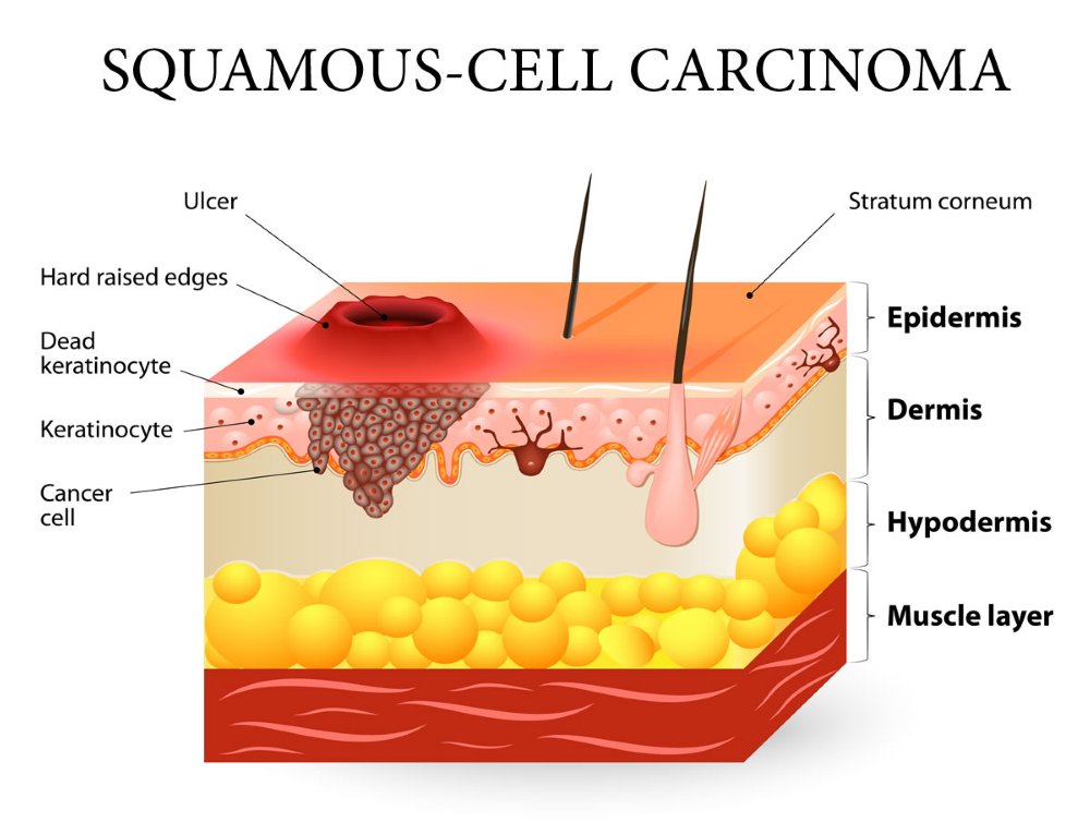 Squamous Cell Carcinoma Dr Jamie Ryan