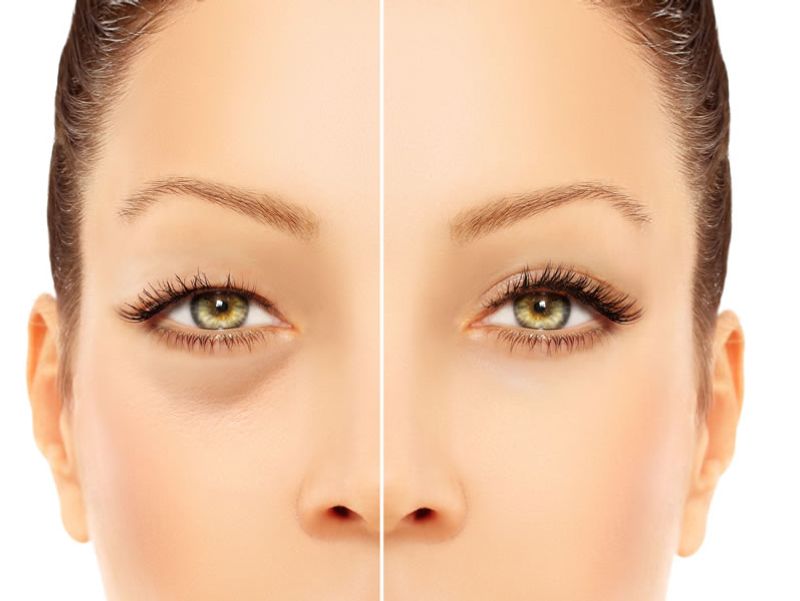 Blepharoplasty