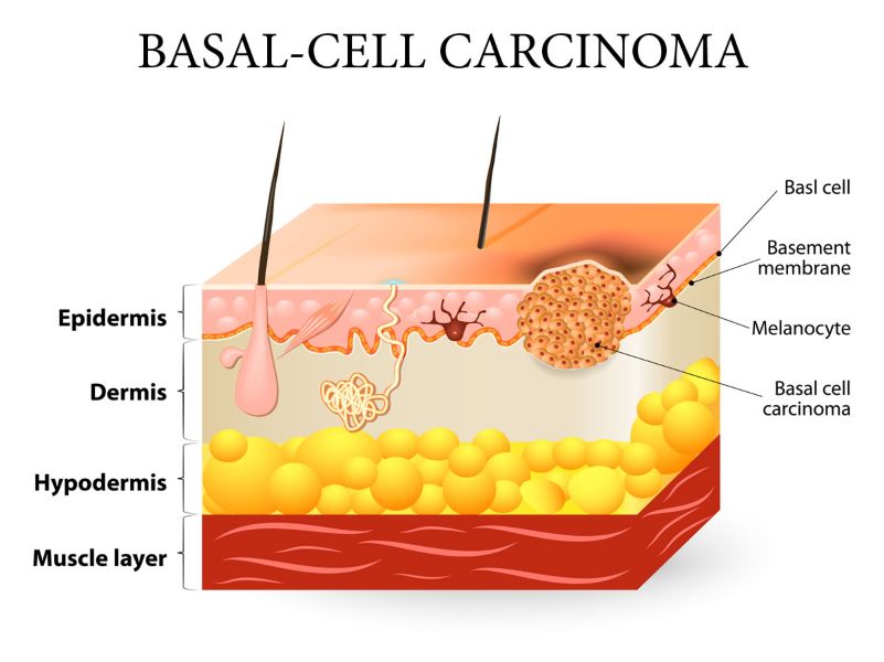 Basal Cell Carcinoma