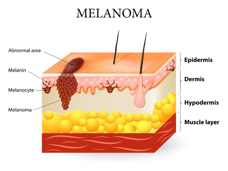 Melanoma