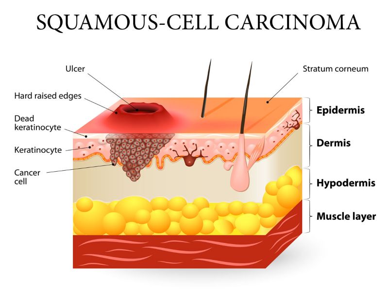 Squamous Cell Carcinoma